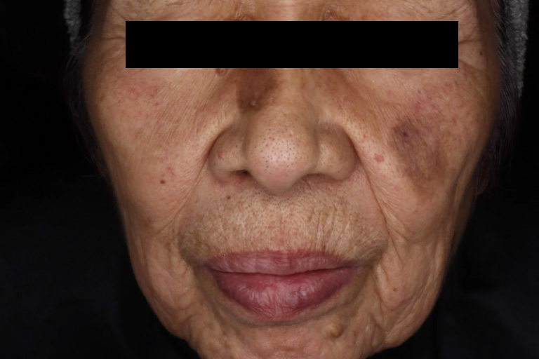 リバースピール施術前