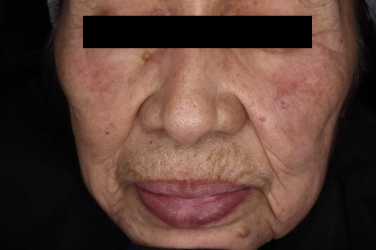 リバースピール7回施術後