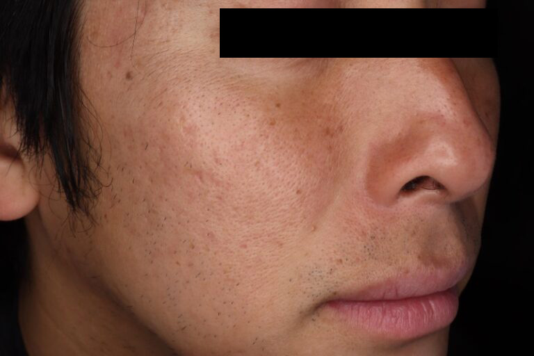 サブシジョン前:横①