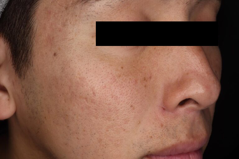 サブシジョン後:横①