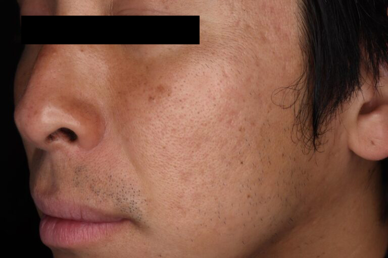 サブシジョン前:横②