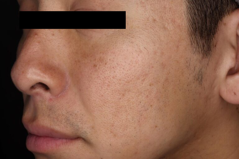 サブシジョン後:横②