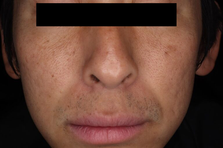 サブシジョン前:正面