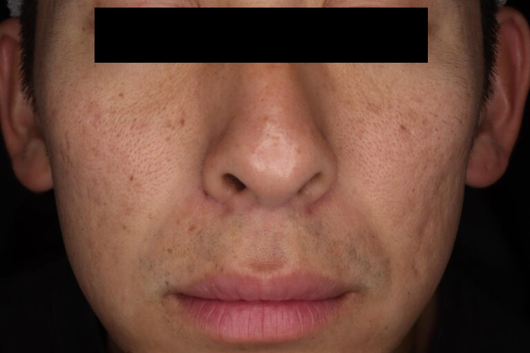 サブシジョン後:正面