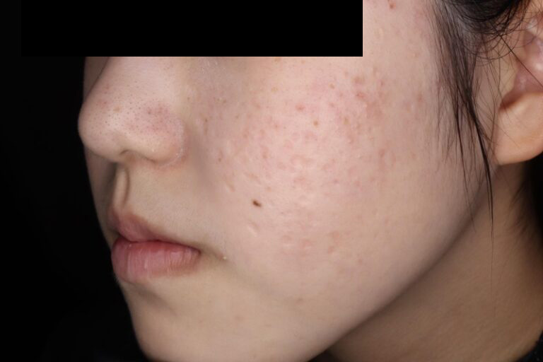 ジュベルック後:横②