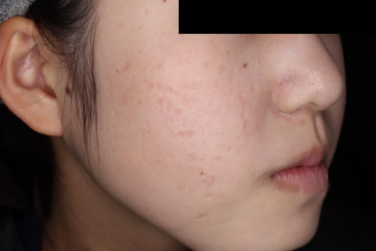 ジュベルック後:横①