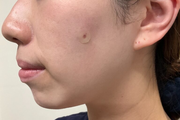 CO2 ほくろ 施術直後テープ貼付