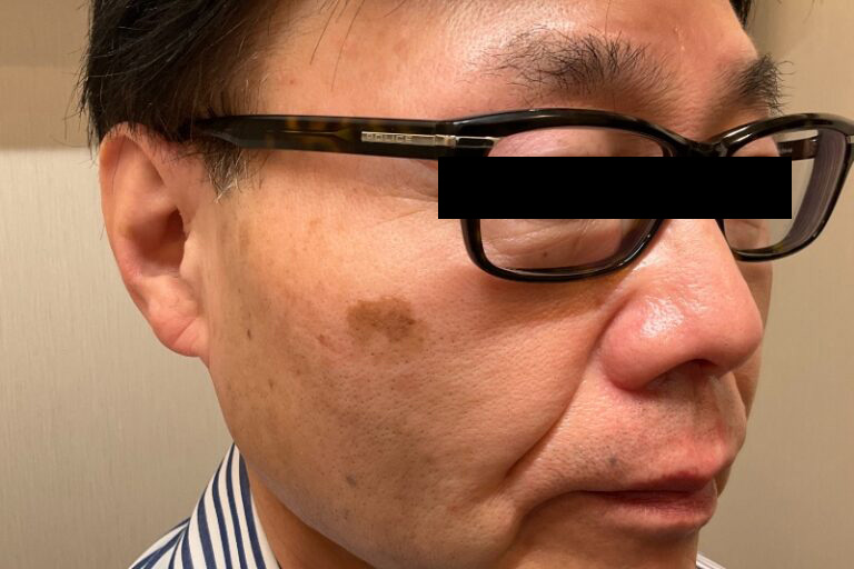 ピコスポット施術前