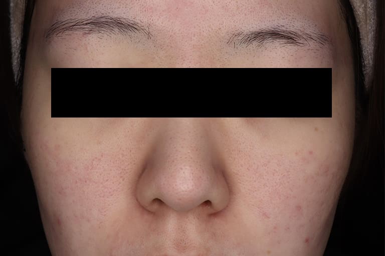 TCAクロス後 正面