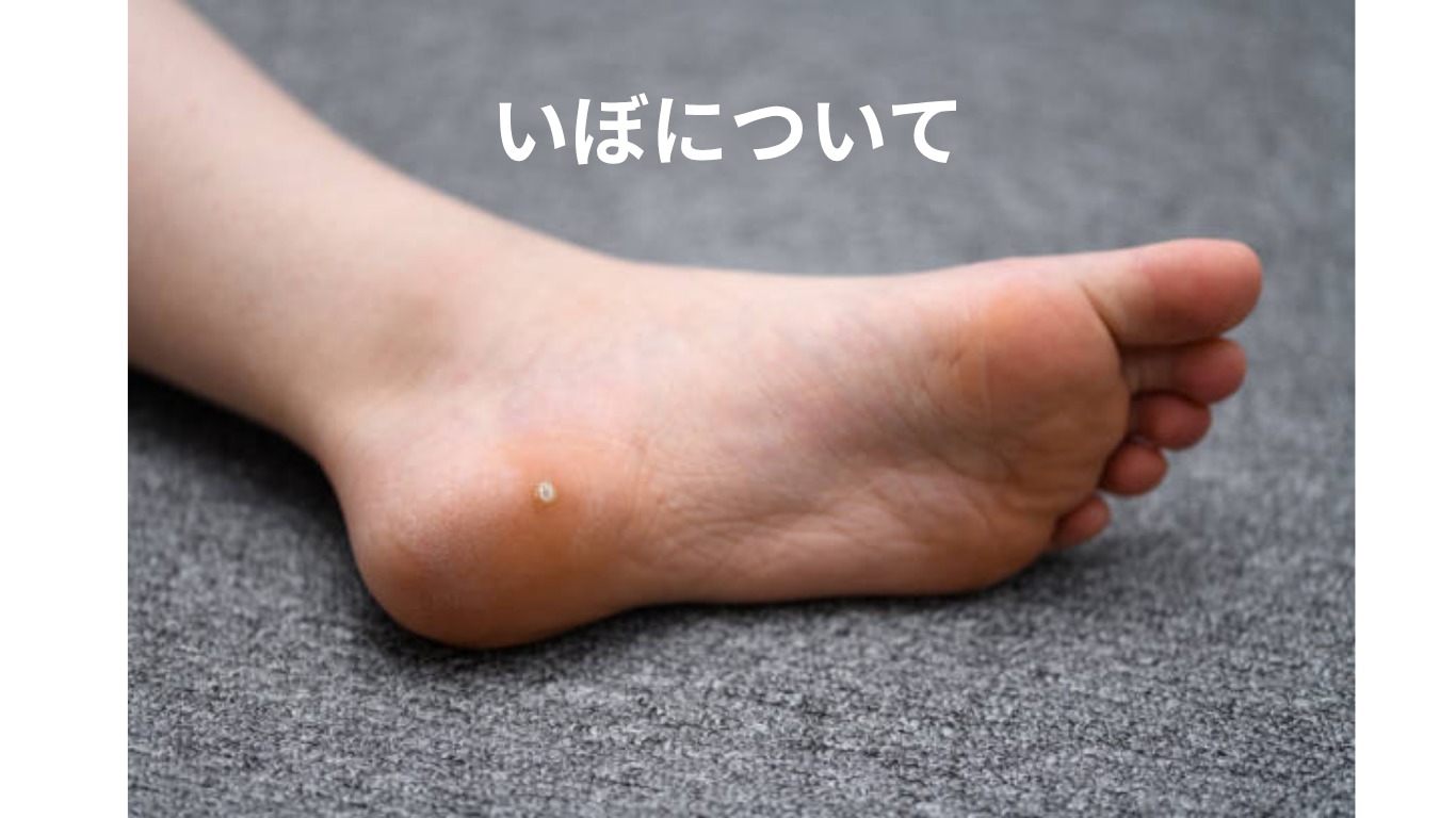 ウイルス性のイボ(尋常性疣贅)