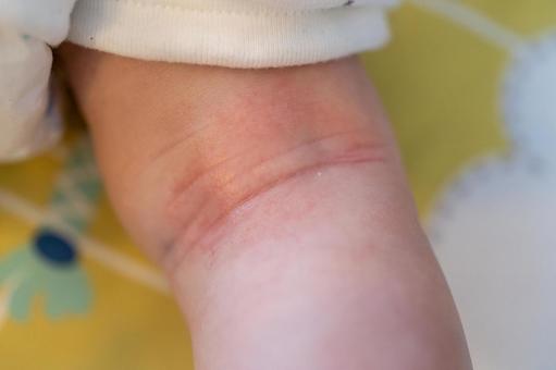 子どもの発疹、受診の目安は？