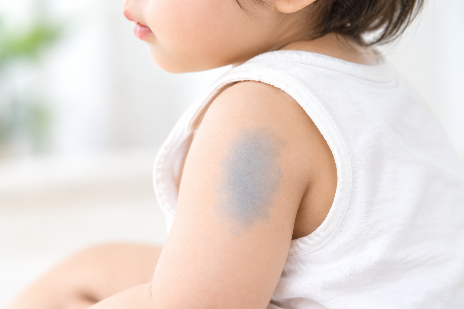 異所性蒙古斑は消える?|子どもの青あざの自然経過とレーザー治療について