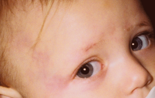 単純性血管腫2